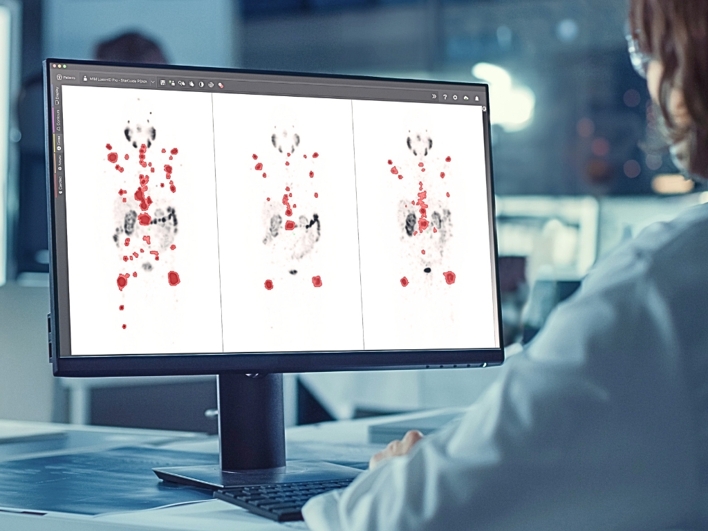 Pantalla de ordenador con imagen diagnóstica de enfermedad