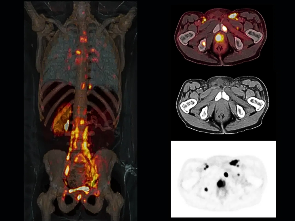 cáncer próstata
